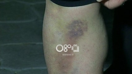 Ora News- Dhuna në kopësht, DAR Korçë paralajmëron masa të rrepta