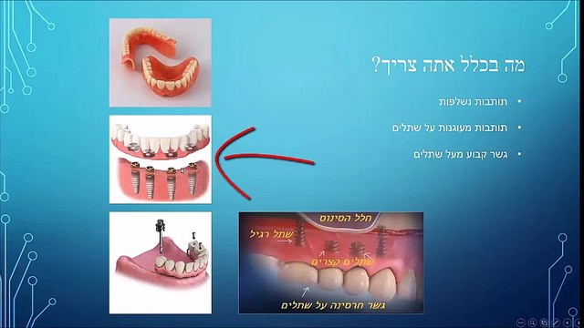 מאיר אבירם - סוגי השתלות שיניים ומחיריהן - חלק 1