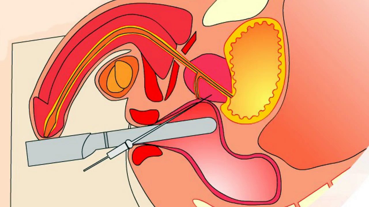 Prostate Diseases Treatment - Zhongba Hospital