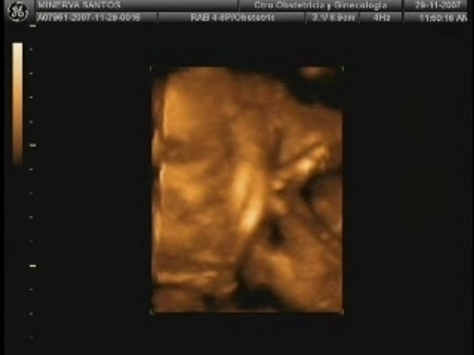 SONOGRAFIA DENISSE 28 SEM