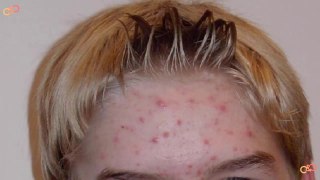 How To Heal Scabs On Face | How To Get Rid Of Scabs On Face Overnight