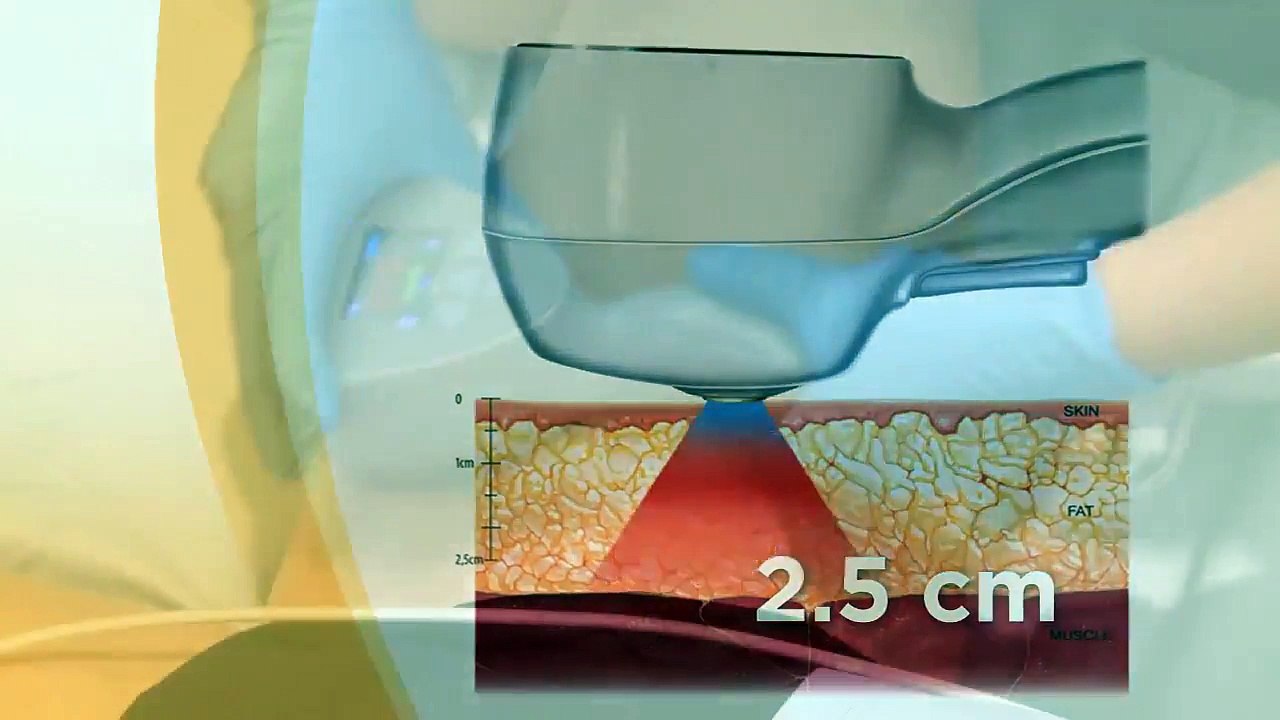 Body Shaping and Contouring with Exilis Elite Technology