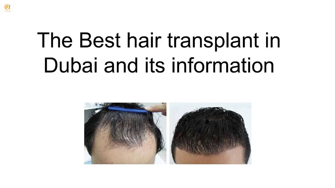 The Best hair transplant in Dubai and its information