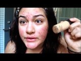 MAC Studio Fix Fluid Foundation: DEMO + REVIEW ON ACNE SKIN [FULL COVERAGE]