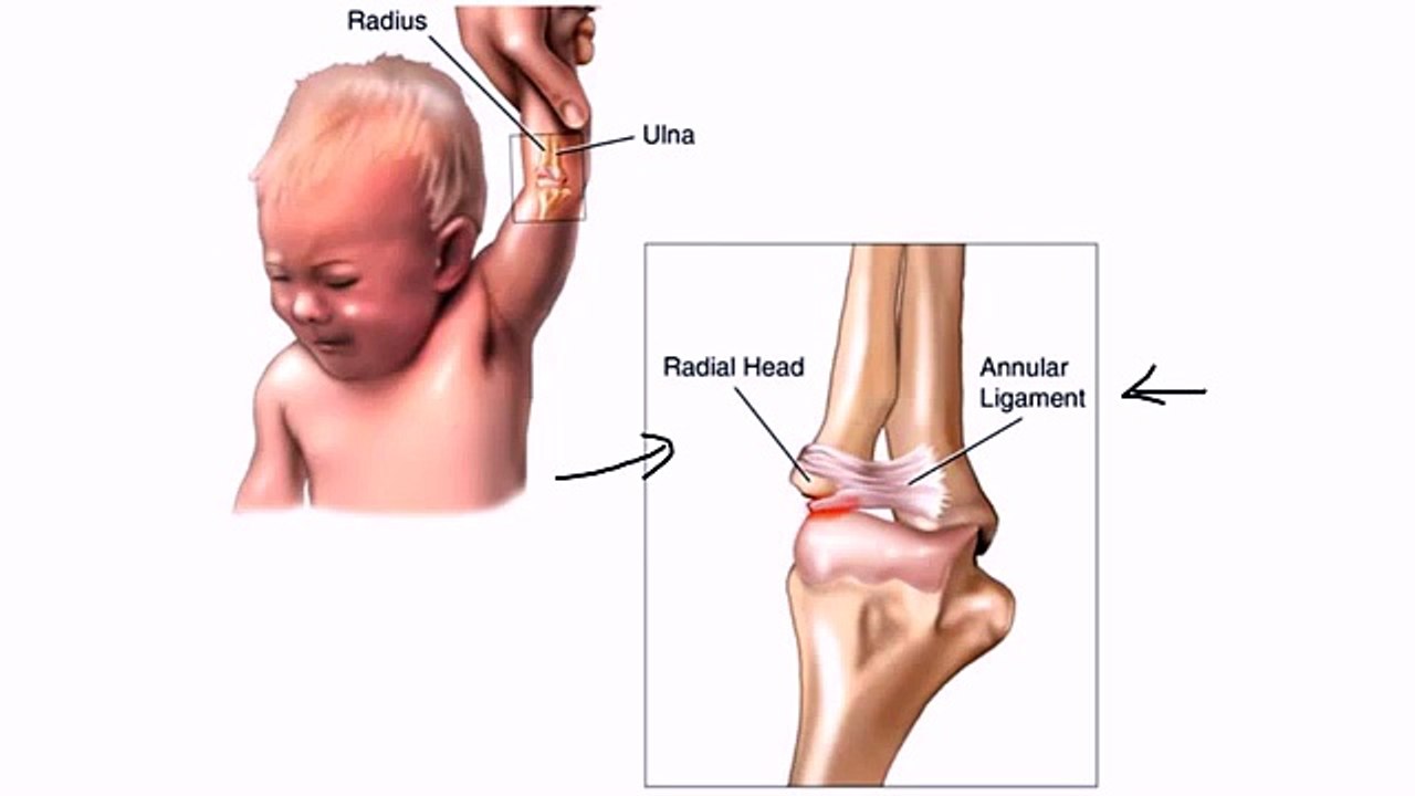 Nursemaids Elbow