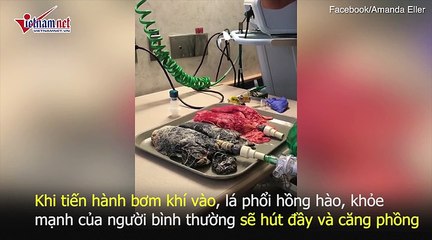 Sốc với video lá phổi đen sì, khò khè vì bị thuốc lá tàn phá