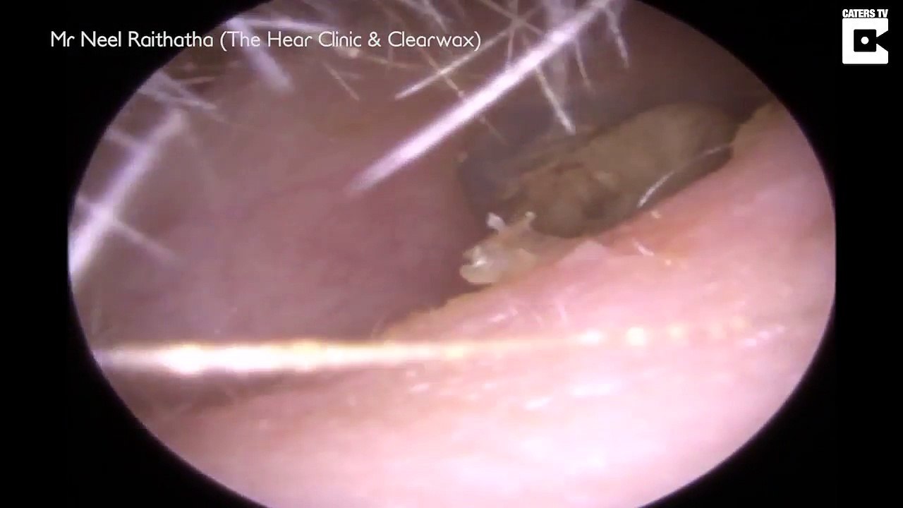 Clip hút hơn triệu lượt xem khi ghi lại cận cảnh bác sĩ lấy ráy tai "khủng" ra khỏi tai bệnh nhân