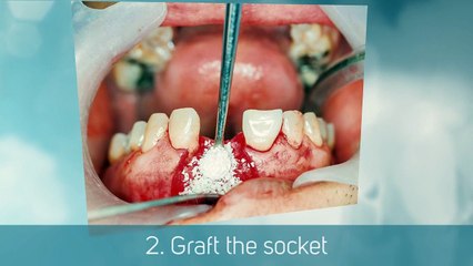 Step By Step Dental Implant Procedure - Vero Beach Art of Dentistry