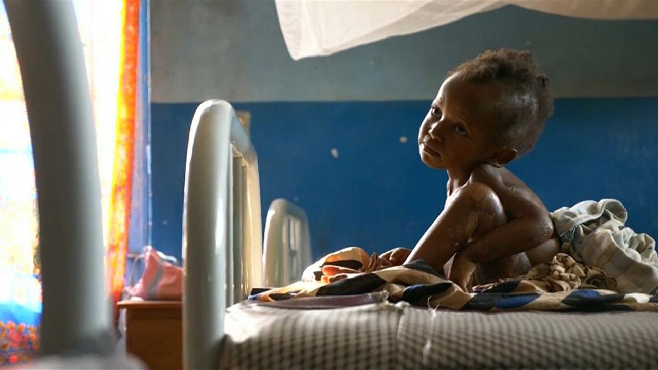 400.000 Kindern im Kongo droht der Hungertod