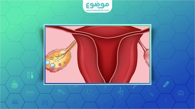 تكيس المبايض والحمل