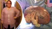 【写真動画】30歳女性の子宮から約23キロの腫瘍を摘出 米 - トモニュース