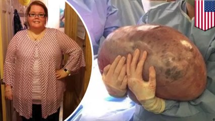 【写真動画】30歳女性の子宮から約23キロの腫瘍を摘出 米 - トモニュース