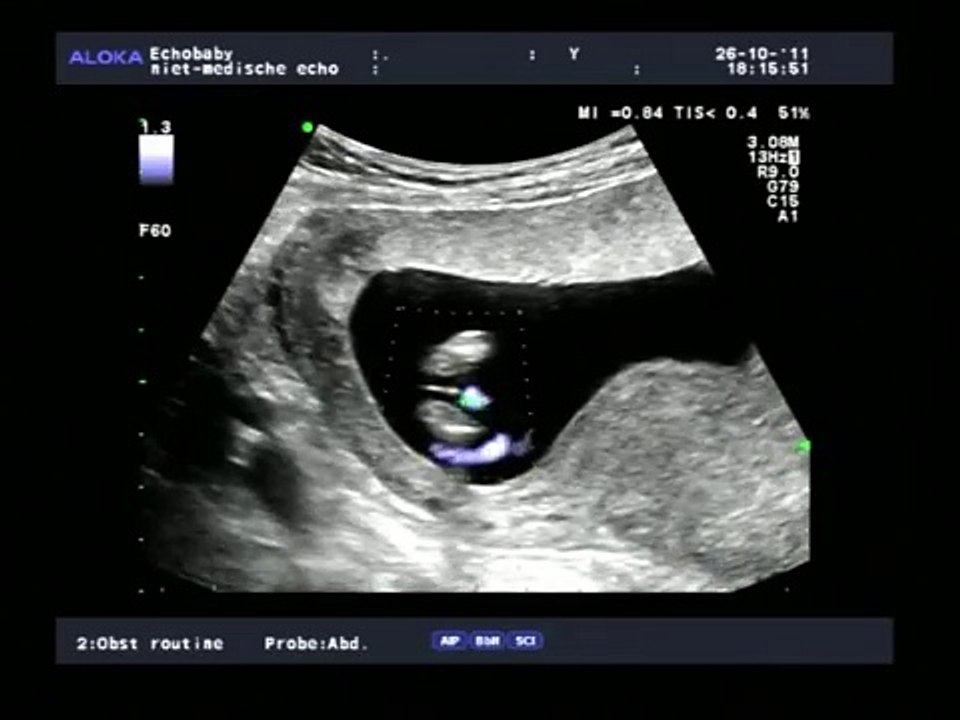 2D-echo met geslachtsbepaling 14 weken jongens