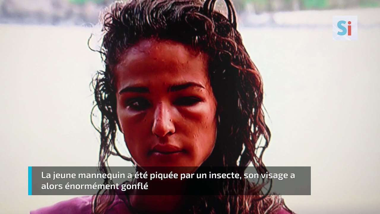 Cassandre de Koh-Lanta défigurée à cause d'un piqure d’insecte