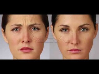 “Pasqyra e Shëndetit” – Eliminimi i rrudhave me botoks (PJ 2)