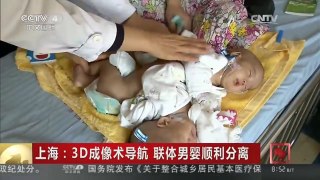 [中国新闻]上海：3D成像术导航 联体男婴顺利分离
