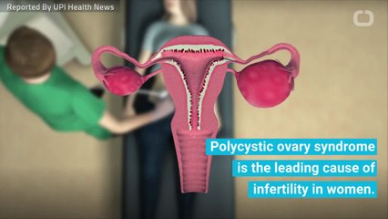 Researchers Identify PCOS-Triggering Hormone