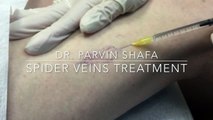 Spider Veins and Varicose Veins Treatment | Irvine Skin