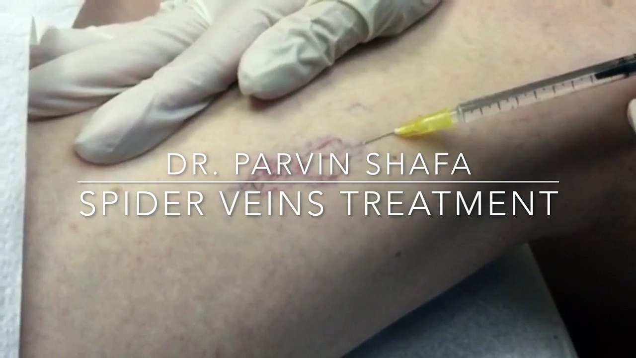Spider Veins and Varicose Veins Treatment | Irvine Skin
