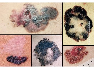 Povećava se broj obolelih od melanoma, 16.maj 2018. (RTV Bor)