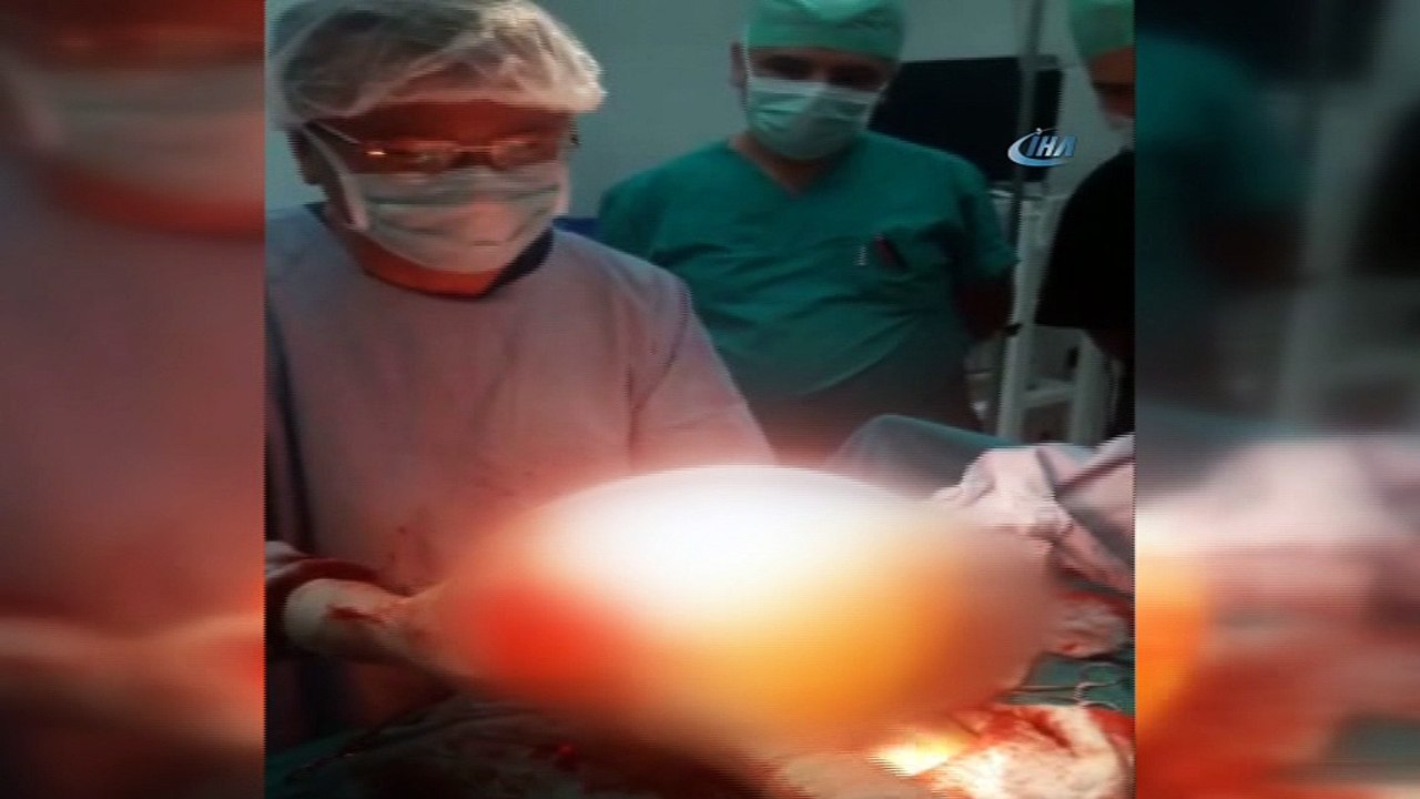 Karnından 7,5 kiloluk dev kist çıkarıldı