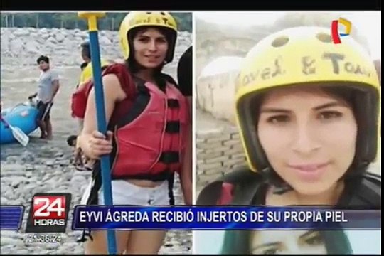 Eyvi Ágreda fue sometida a autoinjerto de piel en octava operación