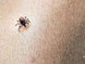 Maladie de Lyme  les bons gestes pour eviter de se faire piquer par des tiques
