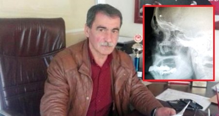 Kafasında Unutulan Kurşunla 40 Yıl Yaşadı: Ölürsem Şehit Olur muyum?