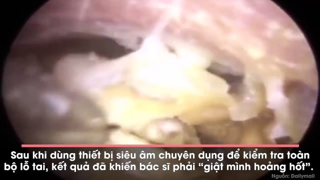 Màn lấy ráy tai “khủng” không nên xem khi đang ăn, càng không dành cho người... ở bẩn