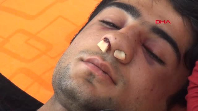 Şanlıurfa Yolda Yürüyen Engelli Gencin Burnunu Kırdılar-
