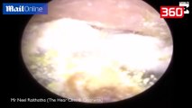 Gruaja kishte mbetur shurdhe nga njëri vesh, kur shkon tek mjeku zbulon të vërtetën shokuese (360video)
