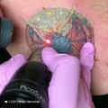 Voilà comment on se fait retirer un tatouage au laser... Douloureux