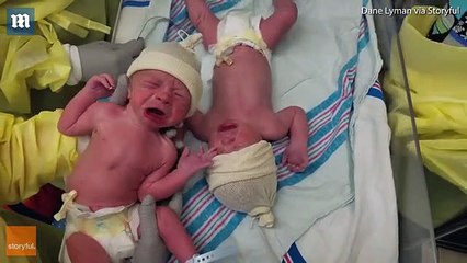 Binjakët e porsalindur qajnë kur i ndajnë, ndalen kur i ribashkojnë