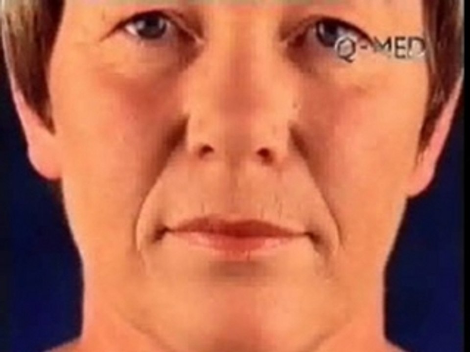 Restylane Dr. Dana