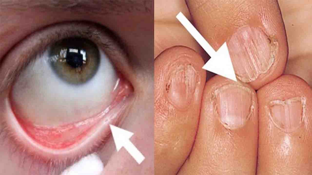 Iron Deficiency Symptoms: आयरन की कमी के लक्षण जानकर हैरान हो जाएंगे आप | Boldsky