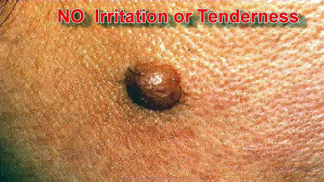 IDENTIFYING ABNORMAL MOLES by Skin cancer Specialist - skincancerclinic.net.au