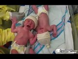 Aralarında Muhteşem Bir Bağ Olup Ayrı Kalamayan Prematüre Bebekler