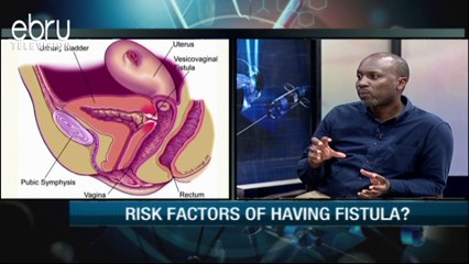 Risk Factors Of Having Fistula