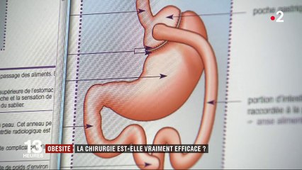 Obésité : la chirurgie est-elle vraiment efficace ?
