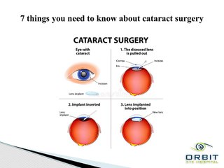 7 things you need to know about cataract surgery