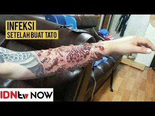 Tangan Pria Ini Berubah Menakutkan karena Infeksi Tato | IDNtv NOW