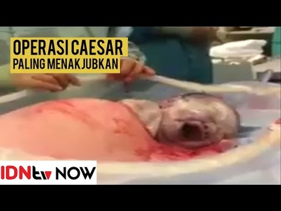 Bayi Ini Merangkak Keluar dari Rahim Ibunya Tanpa Bantuan Dokter | IDNtv NOW