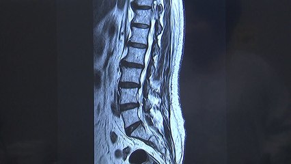 장노년층 허리·다리 통증, 노화 아닌 척추 질환 / YTN