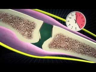 What causes knuckles to make popping sounds?