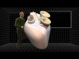Carmat's longer-lasting artificial heart successfully implanted in patient