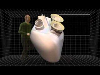Carmat's longer-lasting artificial heart successfully implanted in patient