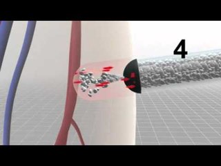 Next Media: Tiny sponges close up gunshot wound in 15 seconds