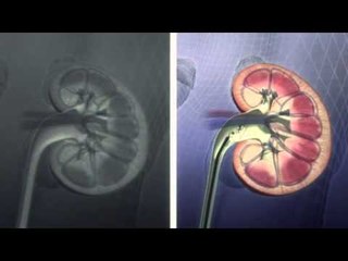 Next Media Video: Pele’s condition improving after surgery