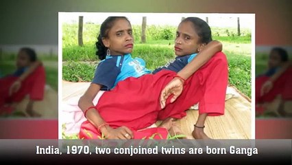 Top 15 People Who Were Born With Extra Body Parts