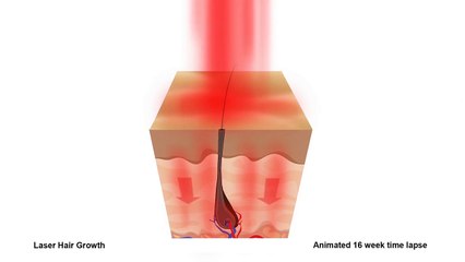 Laser Hair Growth 16 Week Animation - Hair Regrowth Australia